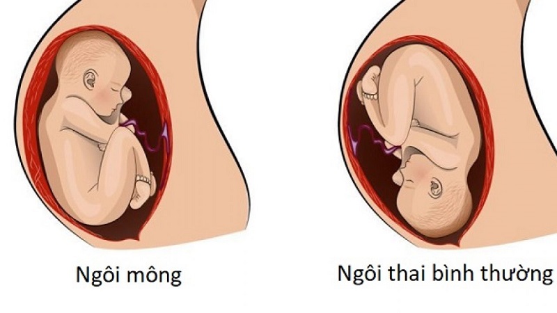 Hình ảnh mô tả ngôi thai